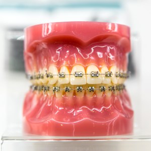 Braces in San Bernardino: 5 Types You Need to Know