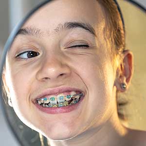 When Do Kids Generally Need Braces in San Bernardino?